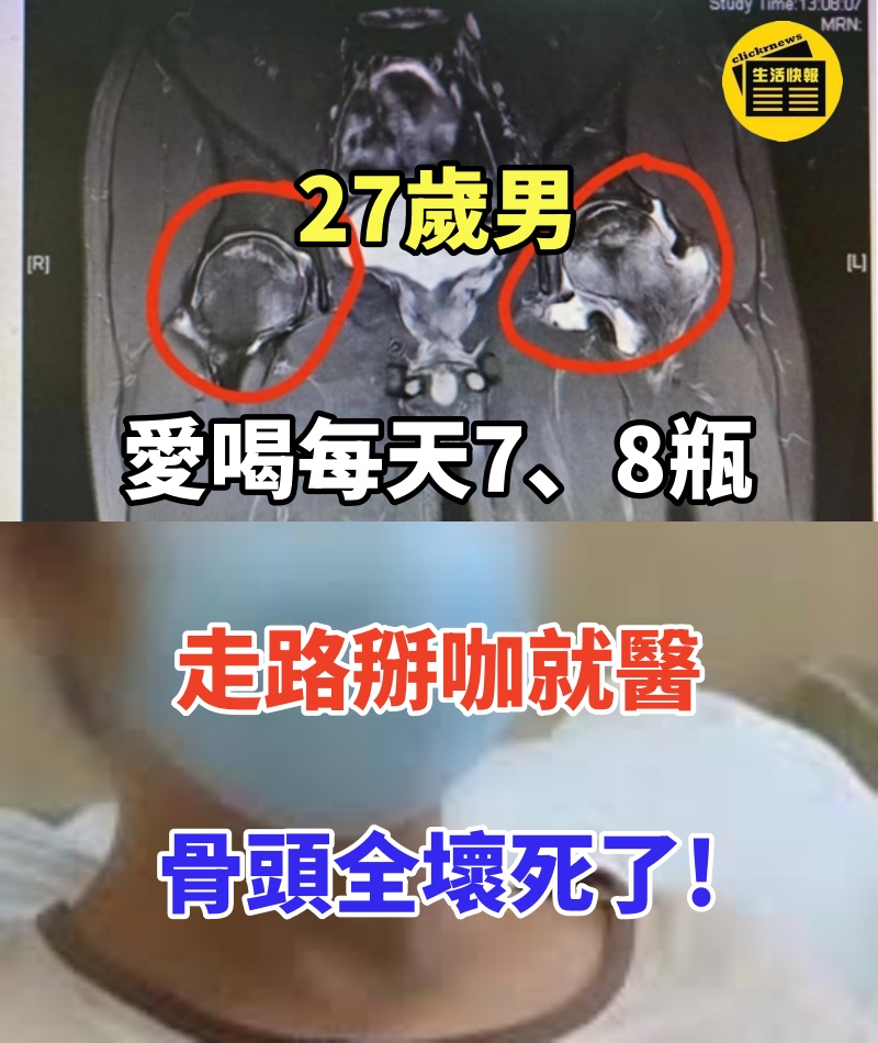27歲男愛喝每天7、8瓶,　走路掰咖就醫：骨頭全壞死了!