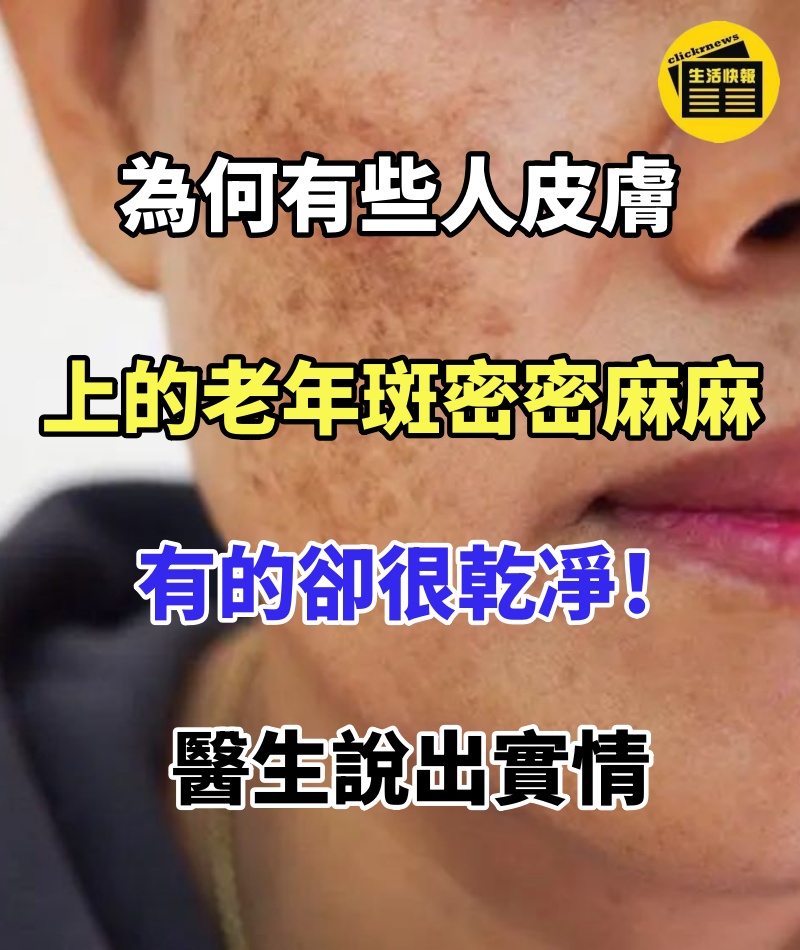 都是50歲!為何有些人皮膚上的老年斑「密密麻麻」有的卻很乾凈!醫生說出實情