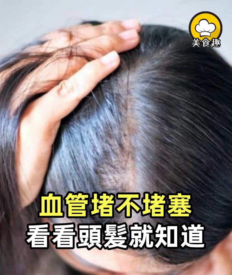 血管堵不堵塞，看看頭髮就知道，一看一個准，為自己收藏！