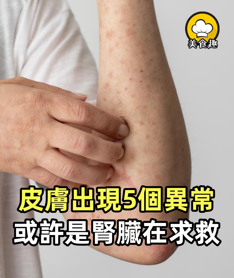 不是皮膚病而是腎衰竭報警？皮膚出現5個異常，或許是腎臟在求救